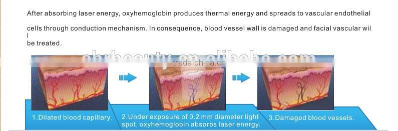 980nm diode laser Cosmetology Machine Vascular Removal Laser Machine