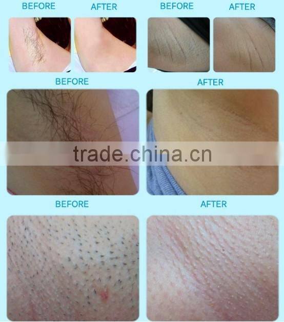 Korea technology Permanent hair removel wrinkle and acne removal opt shr hair removal machine in china