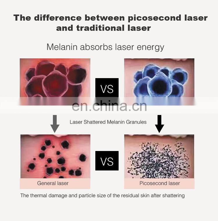 ND YAG Pico second Good Way Laser Pigment Remover Eyebrow Tattoo Removal Machine