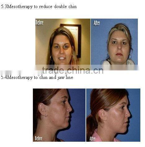 VY-798 Hot sell injection mesotherapy gun products for skin rejuvenation