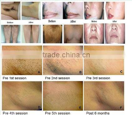 Professional beauty Equipment IPL 2015 RF laser hair removal system