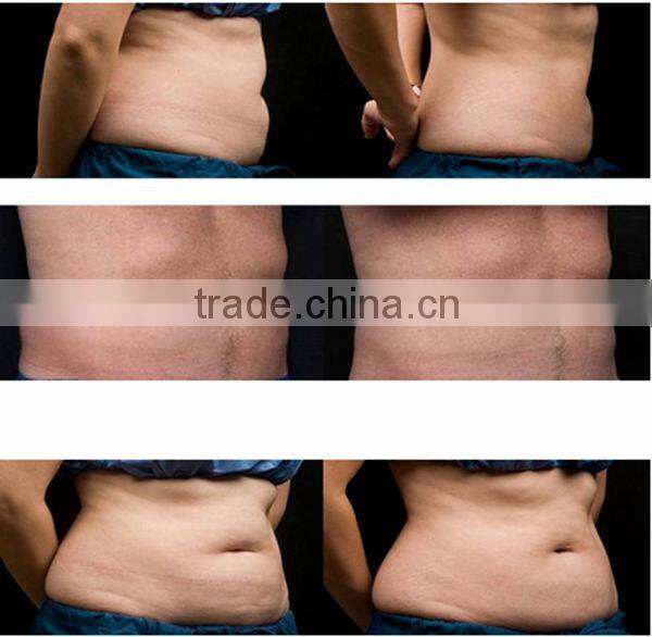 2014 best-selling multifunctional cavi/rf/vacuum beauty salon use ultra lipo cavitation+rf beauty slimming machine