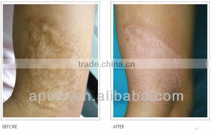 skin care laser erbium yag fractional laser HS 820 rosacea treatment by shanghai med apolo medical