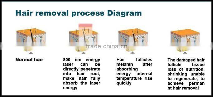 2017 Top quality 808nm diode permanent laser hair remover