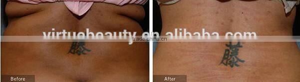 Portable Lipo Laser for fat removal equipment home use