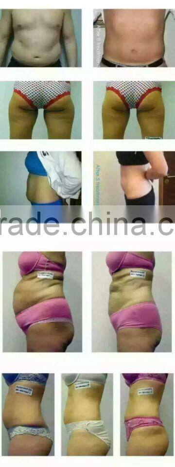 Professional Face Lift Hifu Ultra Slimming Machine With Liposonix