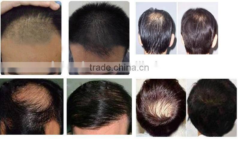 laser 670nm best hair growth treatment
