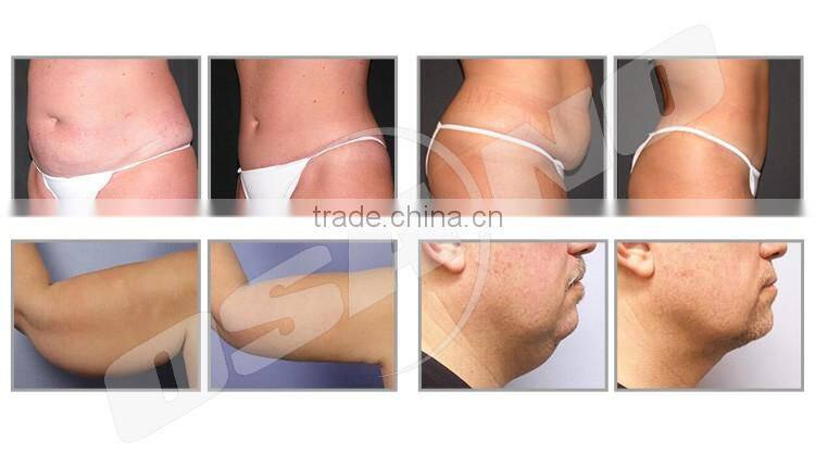 Non invasive lipo laser machine fda approved