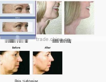 on sales whole sales price Crystal RF Bipolar or Tripolar RF+Bio pen+Cool treatment