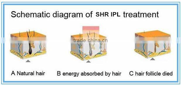 latest design 24 months warranty painless ipl opt shr hair removal laser