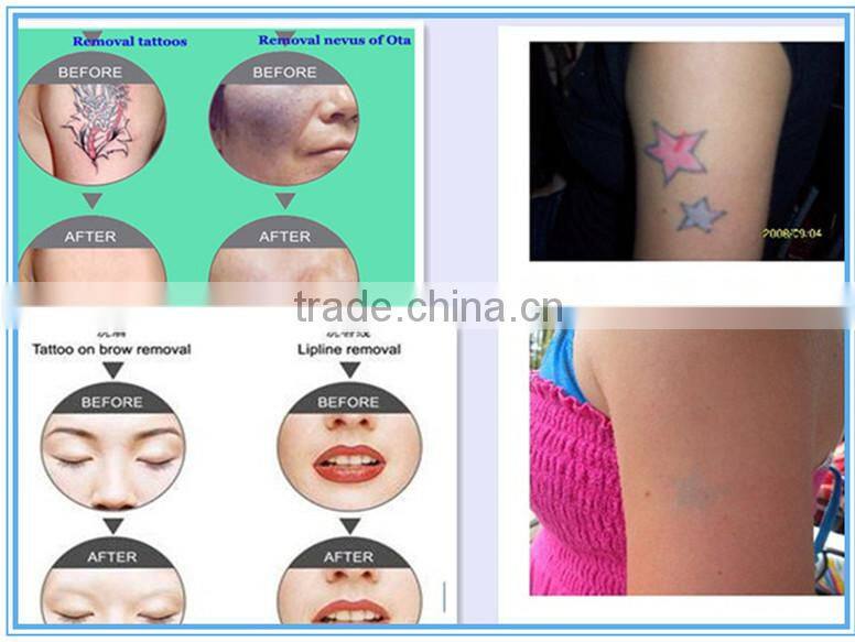 new technology nd yag laser tattoo removal machine