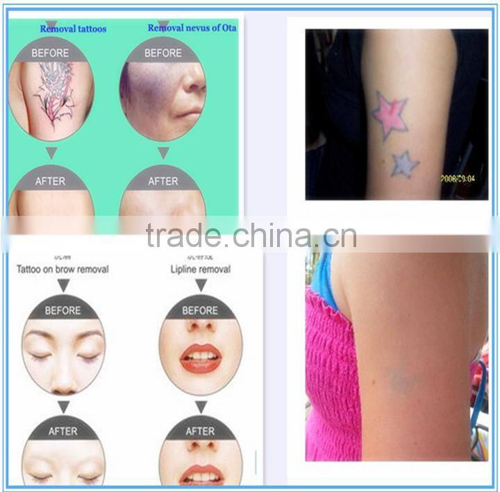 Shipping free portable q-switched laser price