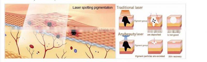 NEWEST home Yag Laser tattoo removal system/professional beauty salon used tatoo remover