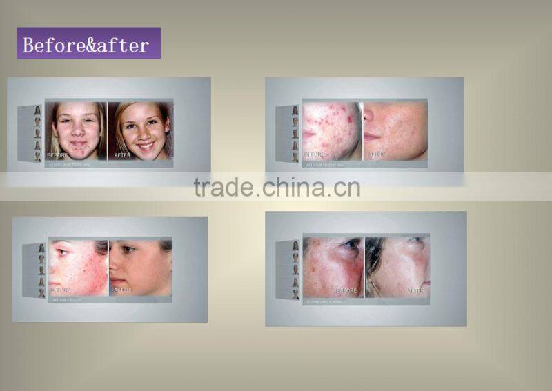 2016 Most advanced Skin Care Face Rejuvenation Facial Hydration Dermabrasion Machine