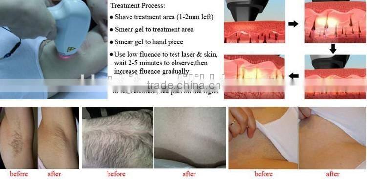 Best price 2015 hair removal machine with CE certificate