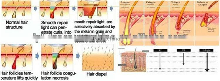 Factory Price!!! New Design Advanced clinic ipl machines for hair removal