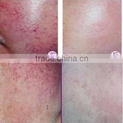 Best painless RBS 30MHz high frequency machine vascular lesions for spa use