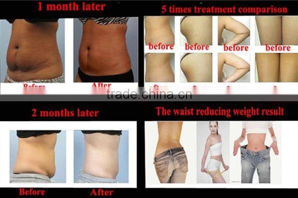 Dual cryo heads cryo lipolisis portable freezing slimming machine CTL76