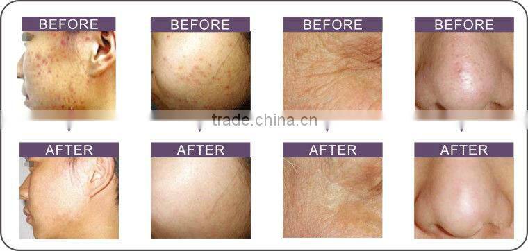 led facial mask for skin rejuvenation