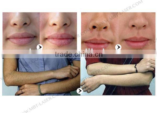 *** New SR & HR ipl-beauty equipment e-light +ipl+shr hair removal & skin elight ipl rf depilation