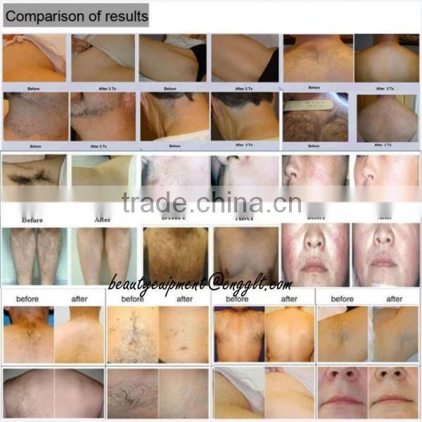 nice epilator diode laser