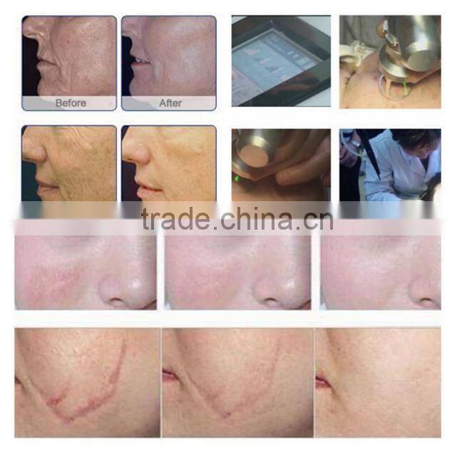 106000nm high fractional Co2 laser machine with gynecology head