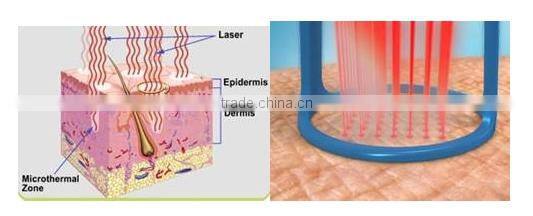 Co2 fractional laser vaginal tightening equipment