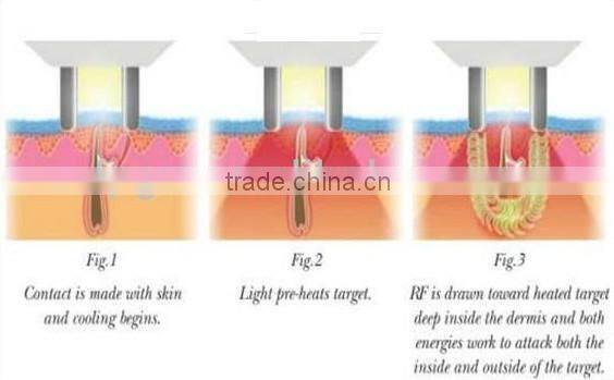 IPL Hair removal & laser tattoo removal beauty machine factory price