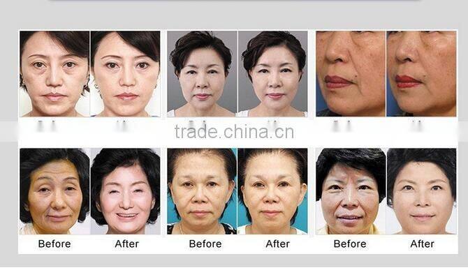 Hot sale 1.5mm/3mm/4.5mm/8mm/13mm anti-wrinkle machine tips for face skin lifting wrinkle removal