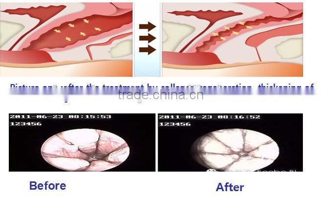 High quality and reliable Laser Gynae machine