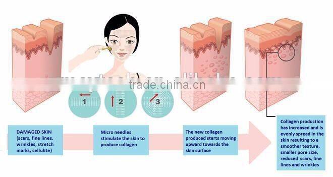 OEM Service acne scarring removal 192 needles dermaroller zgts derma roller 1mm ZGTS192