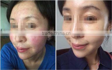 Newest oxygen skin rejuvenation ,pores removal and tightening skin machine for salon and clinic