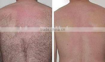 2015 CE approval dilas permanant laser hair removal machine real alexandrite laser machine