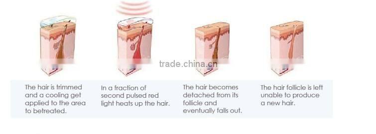Original Germany 808nm diode laser hair removal machine / 810nm diode laser permanent hair remover