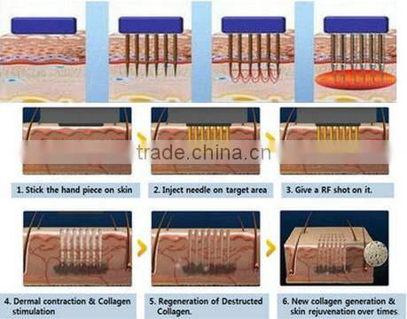 Skin Tightening Fraction Radio Frequency portable rf facial treatment face lifting machine