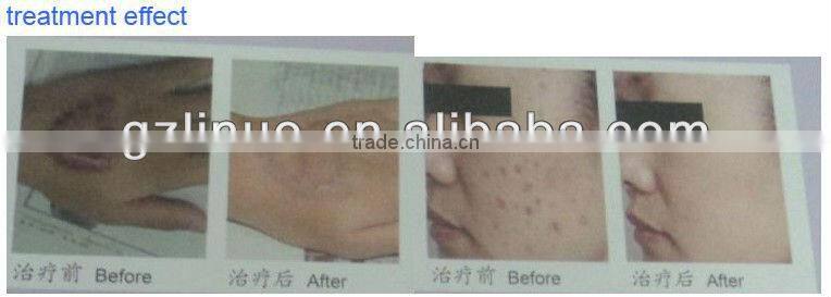 2013 Hottest portable rf remove wrinkles machine portable rf radio frequency machine(wrinkle removal quickly!!!!)