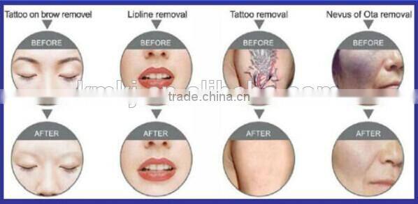 Professional nd yag laser tatoo removal machine pigmentation correctors
