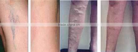 painless hair removal laser medical machine painless nail fungus treat painless vascular treat laser medical machine