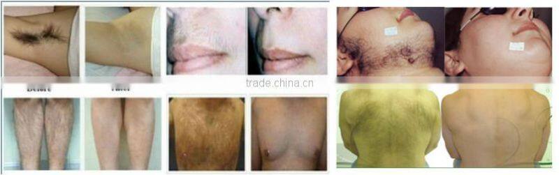 High Quality Facial Care Machine ipl hair removal OPT IPL SHR hair remoal machine