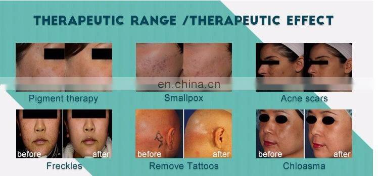 Q-switch tattoo removal system Pico / Pico laser / Picosecond laser portable