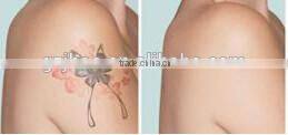 tattoo removal laser beauty equipment eyeline removal machine