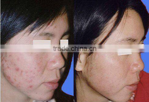 Fractional photoepilation ipl+rf machine elight machine for hair removal and skin rejuvenation C006