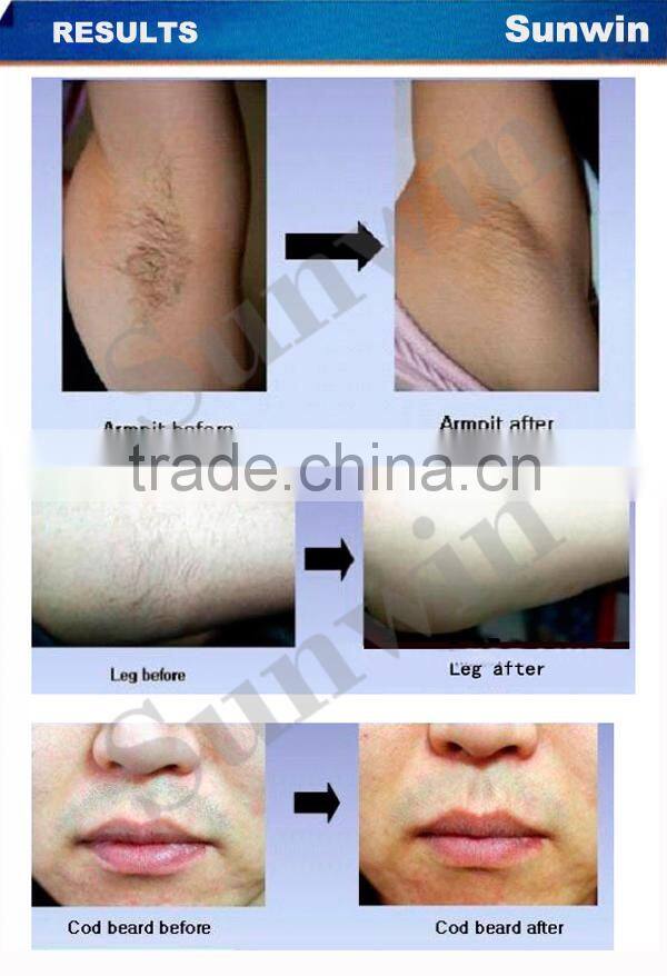 SW-203E E-light IPL RF+ND YAG laser multifunction laser hair removal e-light ipl