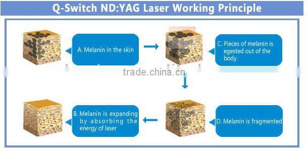 K10 Tattoo Removal Feature Nd: Yag Laser Laser Type tattoo removal machine price
