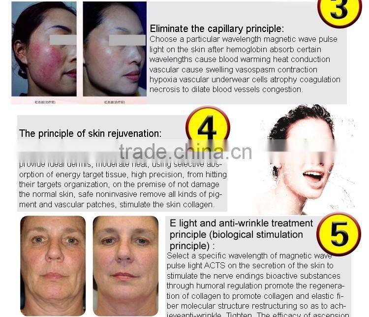 HOT sale E-light RF Hair Removal IPL beauty equipment ipl skin care machine