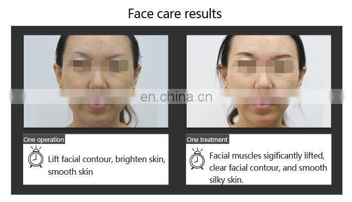 Effective home use device fine lines care eye bag remove slim face ems face lifting device mole removal cream