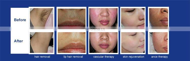 Hot Selling 3 Handles IPL RF/ Nd YAG Laser Tattoo OPT Hair Removal Machine