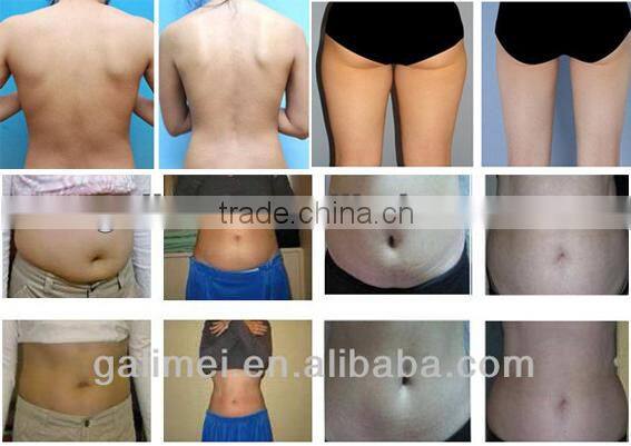 2014 new ce approved laser skin treatment machine