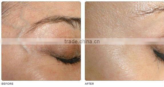 long pulsed nd yag HS 280 varicose veins laser treatment machine by shanghai med apolo medical tech