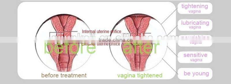 vaginal tightening machine co2 fractional laser equipment